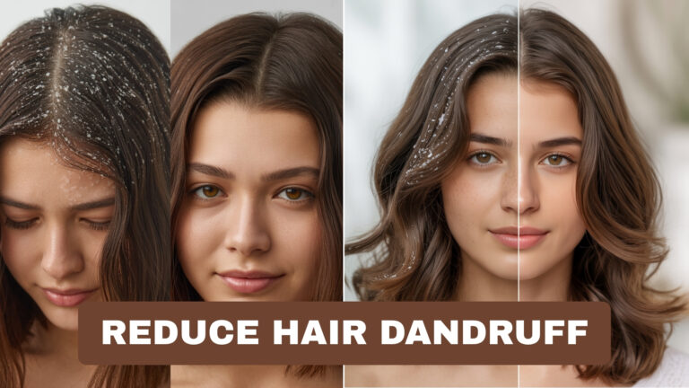 How to Reduce Dandruff Fast: Causes and Remedies