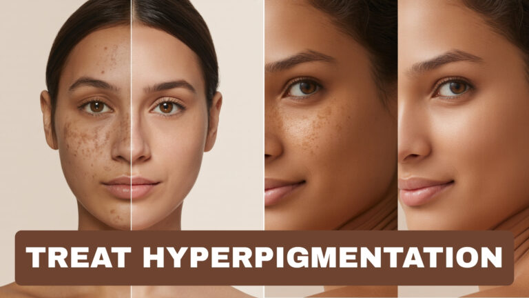 How to Fade Dark Spots and Treat Hyperpigmentation Naturally