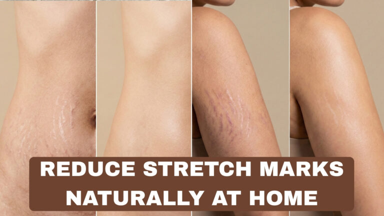 How to Reduce Stretch Marks Naturally at Home